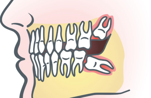 A guide to Wisdom Teeth